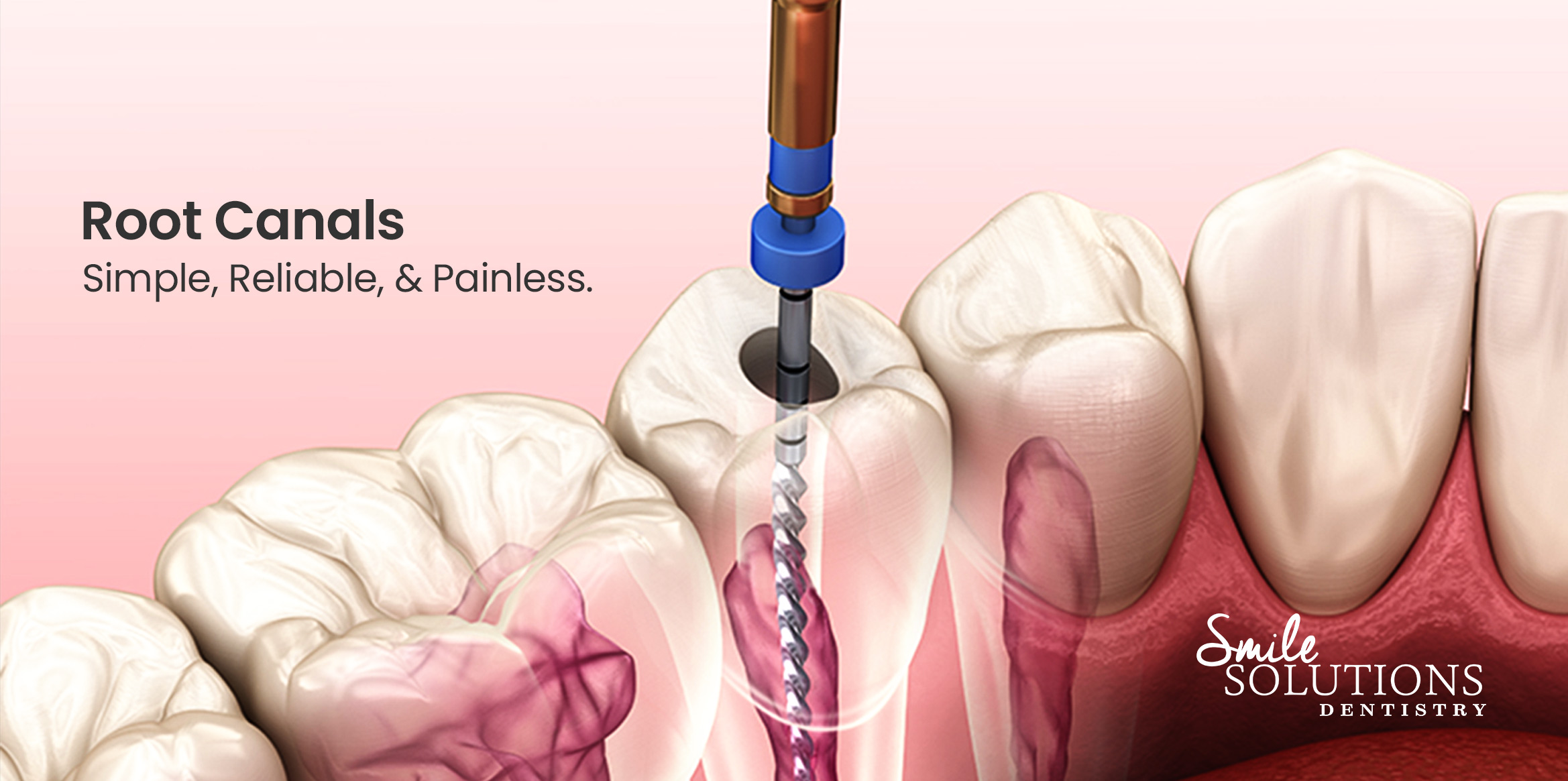 Root Canal Treatment