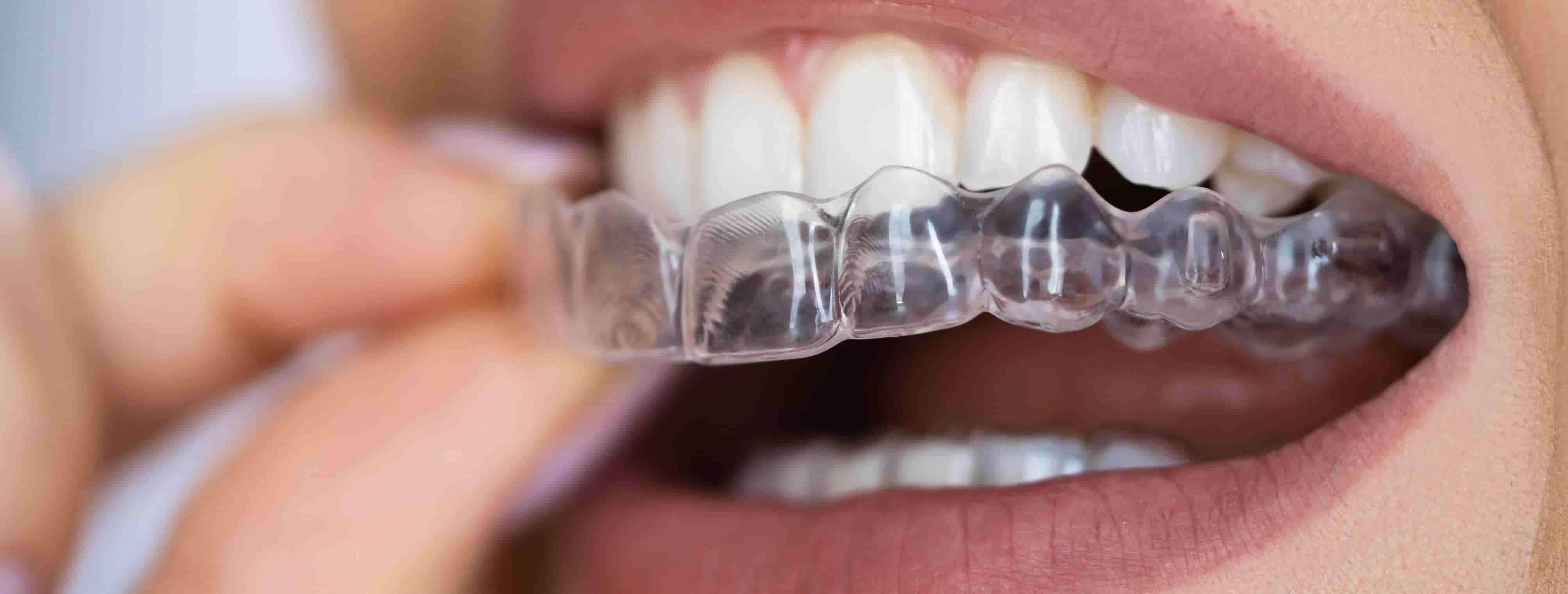 Smile Designing