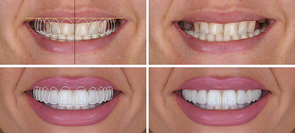 Braces & Aligners
